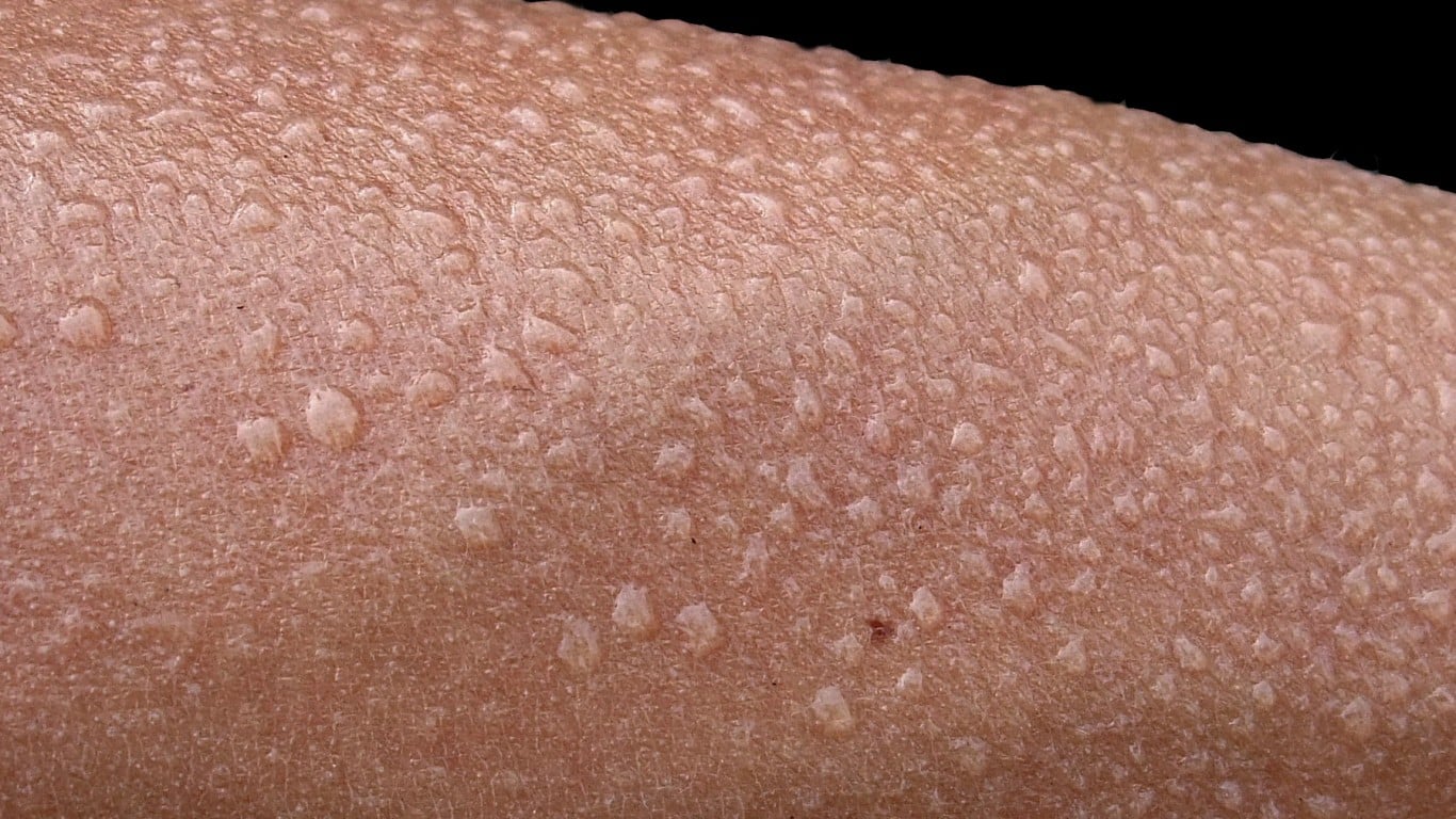 Сыпь везикулярная